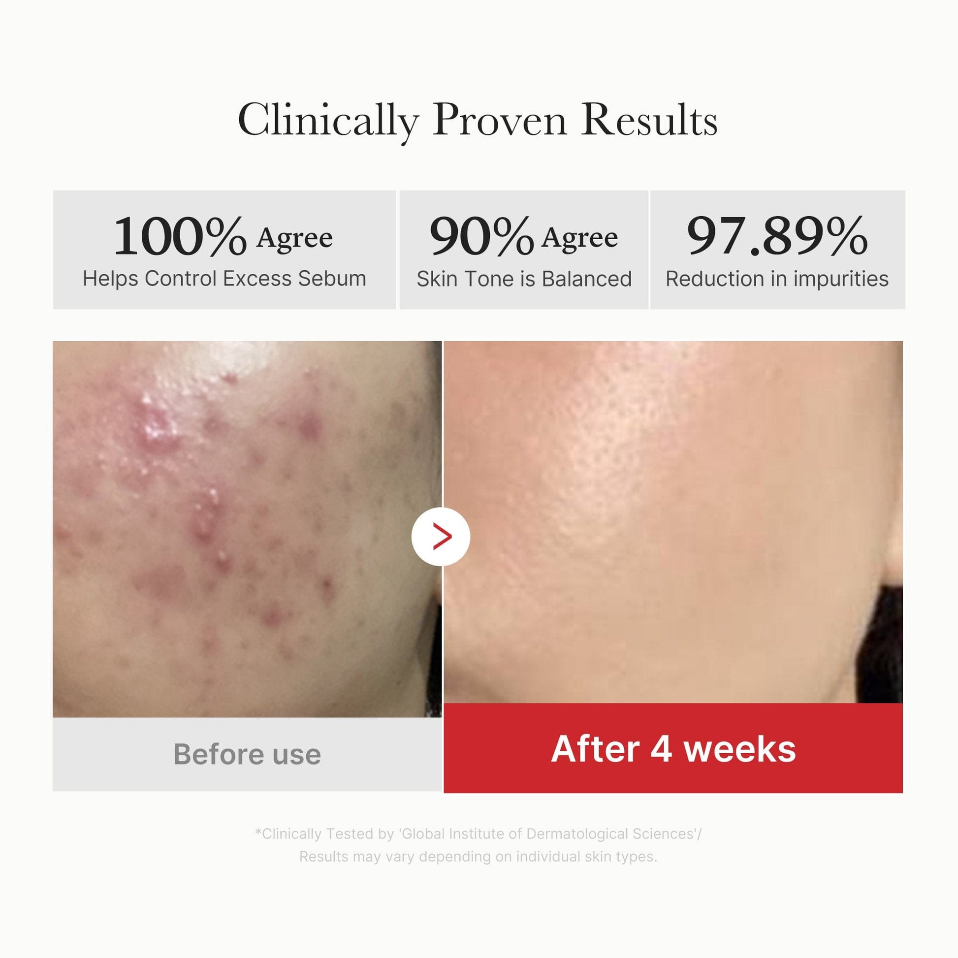 Red Succinic Acid Acne Peeling Pads