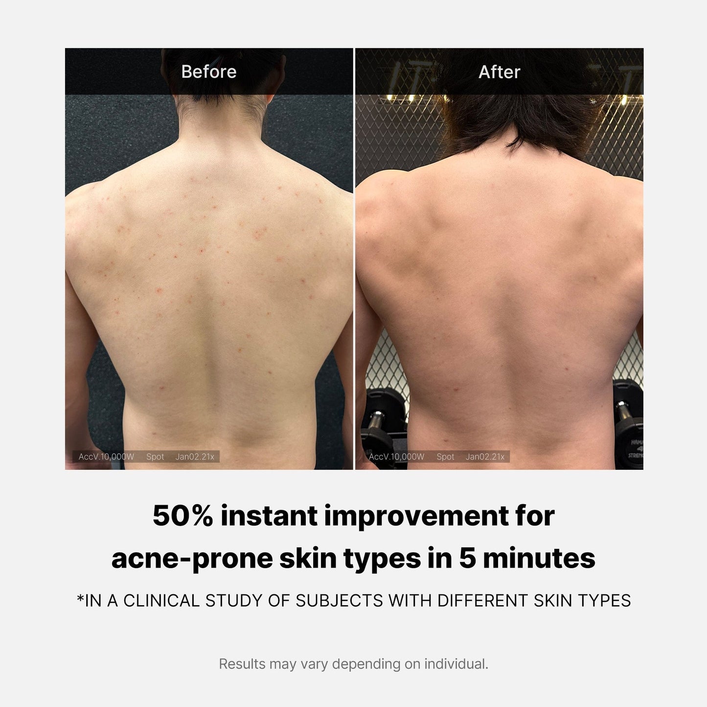 [Salicylic Acid Body Cleanser] Red Acne Body Wash