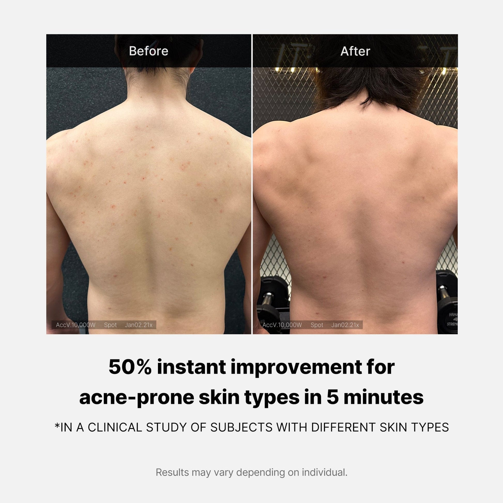 [Salicylic Acid Body Cleanser] Red Acne Body Wash