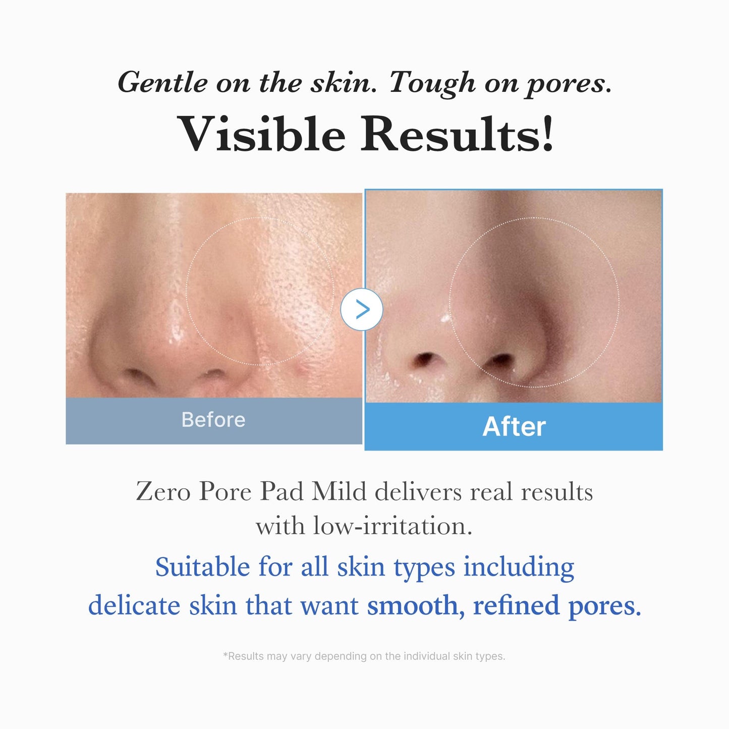 Zero Pore Pad Mild